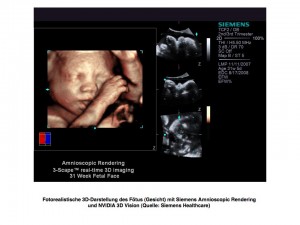 SH Amnioscopic 2 prev